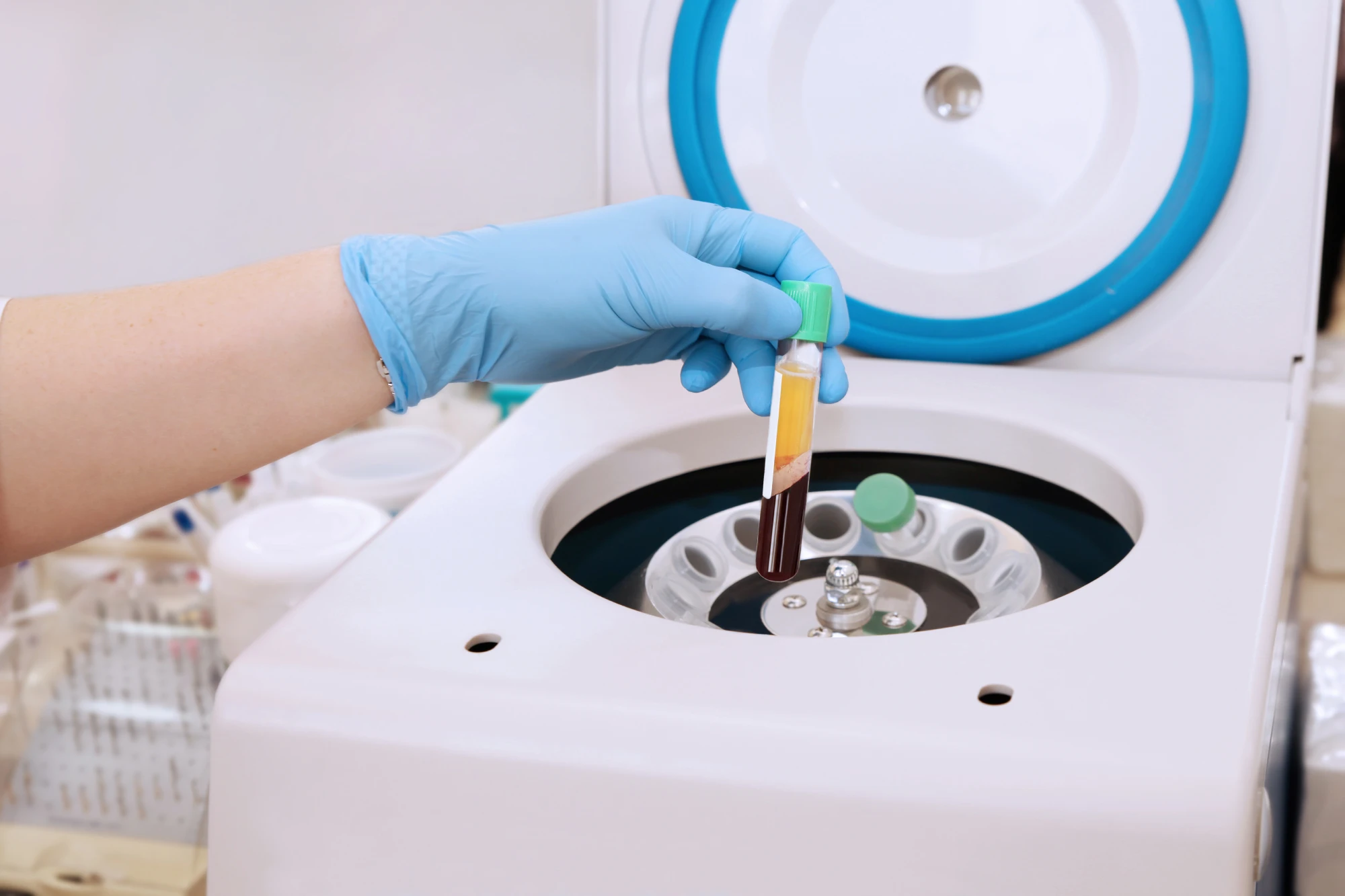 PRP blood preparation at The Re Clinic